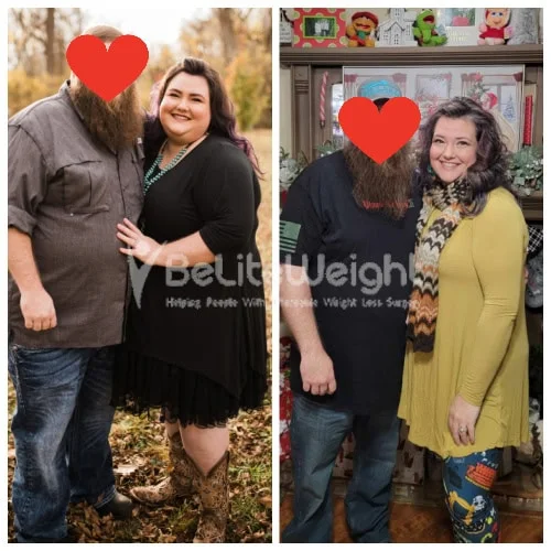 RNY Gastric Bypass before and after Patient - I started out at 356 and am down to 208. Still working on it. Best...