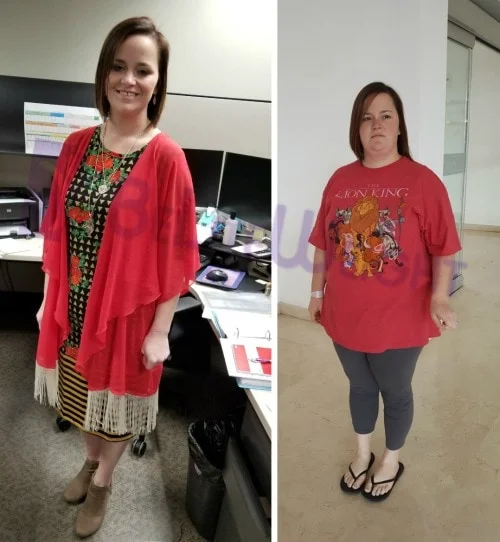 Weight Loss Surgery before and after Patient - Surgeon Dr. Jose Rodriguez Procedure Gastric Sleeve *See Below