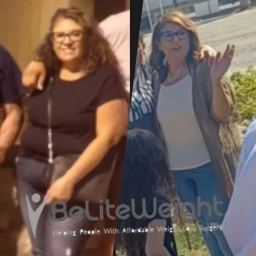 Weight Loss Surgery Before And After