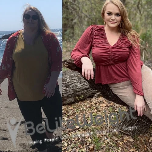 Weight Loss Surgery Gastric Sleeve before and after