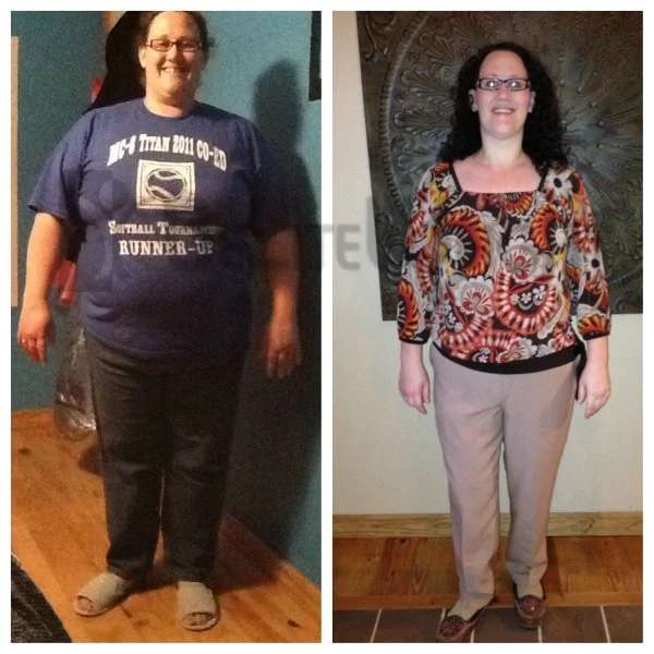 Amanda - Weight Loss Surgery Before and After
