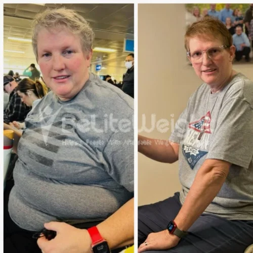 Mini Gastric Bypass before and after Patient - Yes it's been a year and I have lost 100Lb. Doing great thus far. Thanks for...