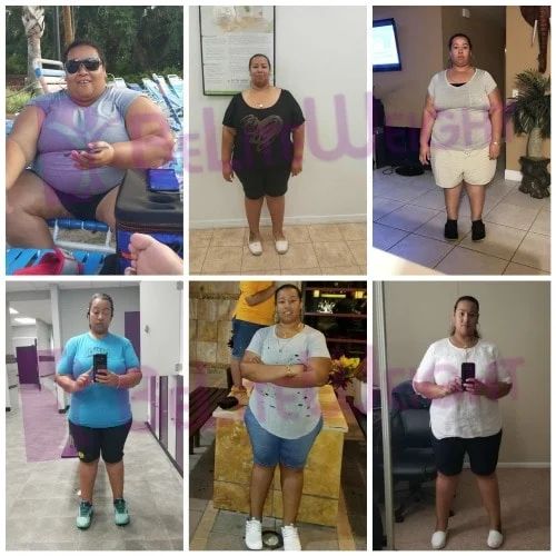 Weight Loss Surgery before and after Patient - I am very pleased and very happy with my results. I lost 160lb in 1...