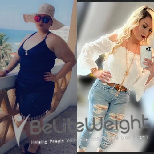 Weight Loss Surgery Before And After