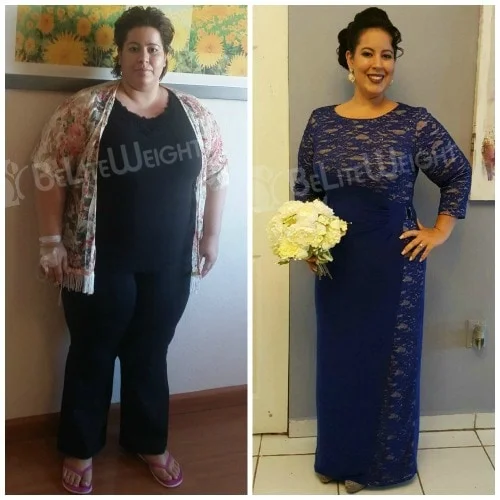 weight loss surgery before and after gastric sleeve bypass vsg