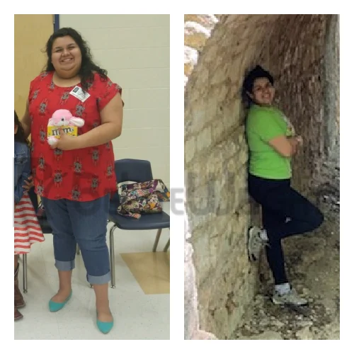 Weight Loss with Gastric Sleeve Surgery