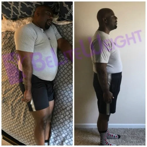 weight loss surgery before and after vsg gastric bypass sleeve vertical