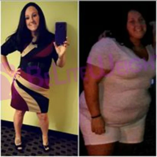 weight loss surgery success story before and after vsg sleeve bariatric
