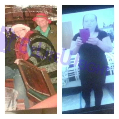 VSG Weight Loss Sleeve Before and After Photos