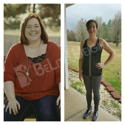 weight loss surgery vsg gastric sleeve before after photos testimonial revision after lap band