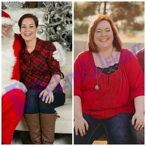 weight loss surgery vsg gastric sleeve before after photos testimonial bypass