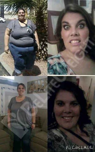 weight loss surgery success stories before and after vsg gastric sleeve bariatric