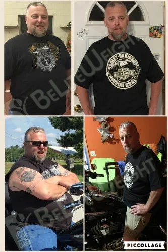 weight loss surgery vsg before after bariatric sleeve vertical bypass