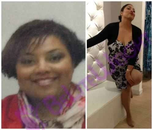 weight loss surgery before and after vsg gastric bariatric sleeve lap band bypass mini