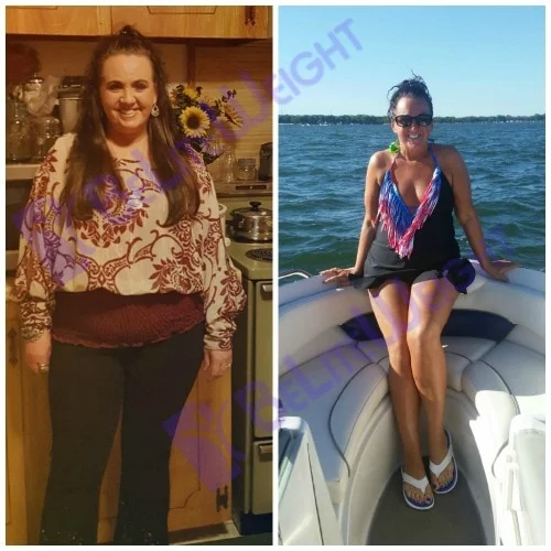 weight loss surgery bariatric gastric vsg sleeve bypass band