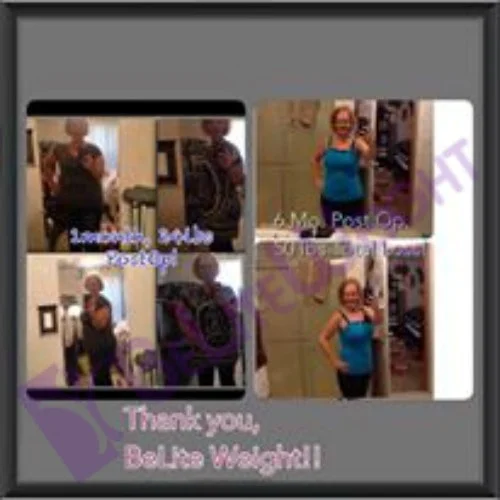 weight loss surgery success story before and after vsg gastric sleeve bariatric