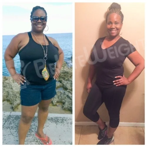 weight loss surgery vsg gastric sleeve before after photos testimonial