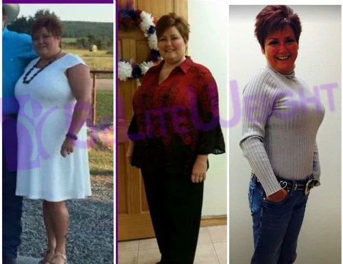 vsg gastric sleeve weight loss before and after surgery