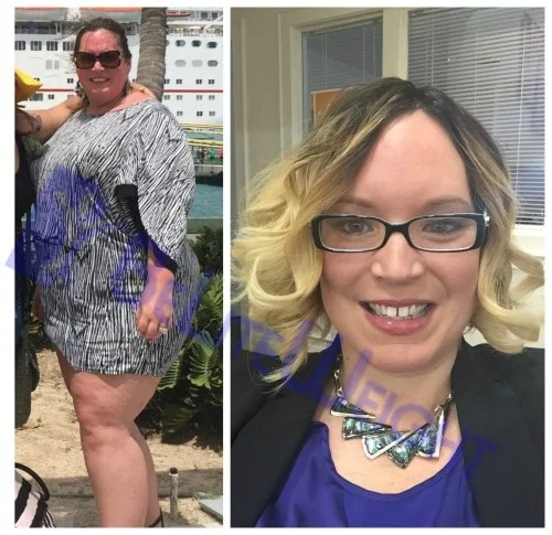 weight loss surgery before and after sleeve bypass vsg bariatric healthy fat loss