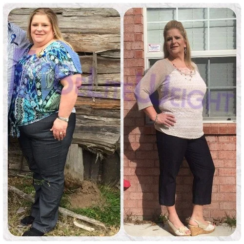 weight loss surgery vsg gastric sleeve before after photos testimonial revision after lap band