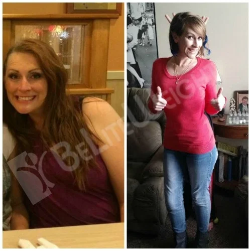 weight loss surgery vsg gastric sleeve before after photos testimonial bypass