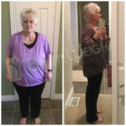 Weight Loss Surgery before and after Patient - * Surgeons  Dr. Jose Rodriguez and Dr. Elmo AramburoSurgery Gastric Sleeve*See Below