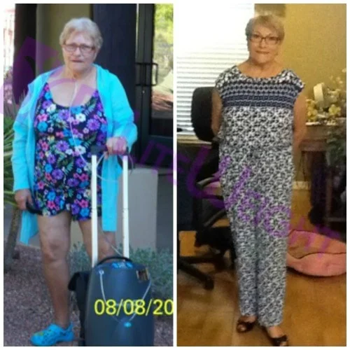 vsg gastric sleeve weight loss before and after surgery