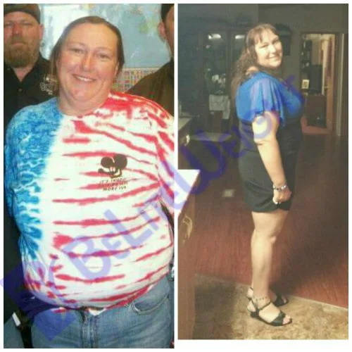 Weight Loss Surgery before and after Patient - Surgeon Dr Jose Rodriguez and Elmo AramburoProcedure Gastric Sleeve*See Below