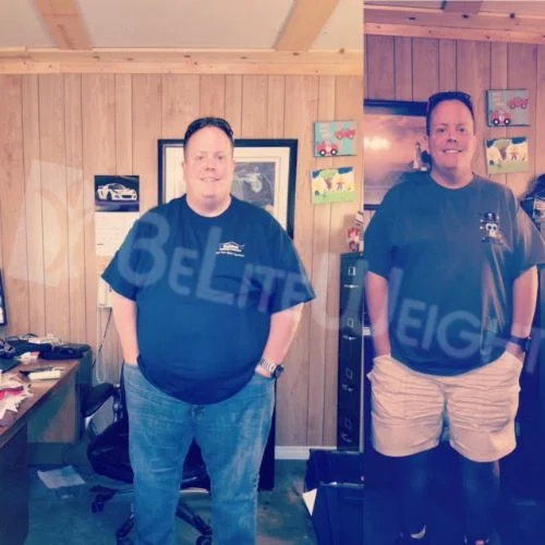 Gastric Sleeve Bariatric Surgery Before and After VSG Photos