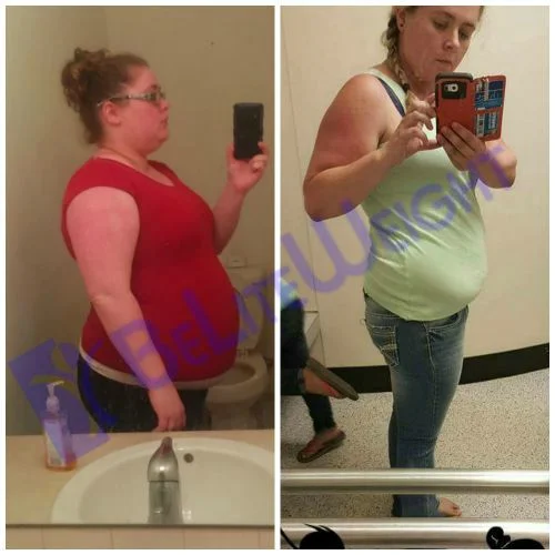 Weight Loss Surgery before and after Patient - I would recommend this procedure to anyone! This is the best decision I have made...