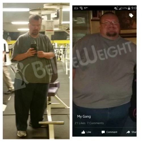 weight loss surgery vsg gastric sleeve before after photos testimonial revision after lap band