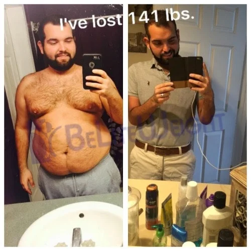 Weight loss surgery gastric bypass before after