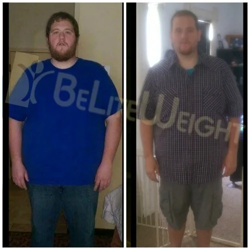 Weight loss surgery gastric bypass before after