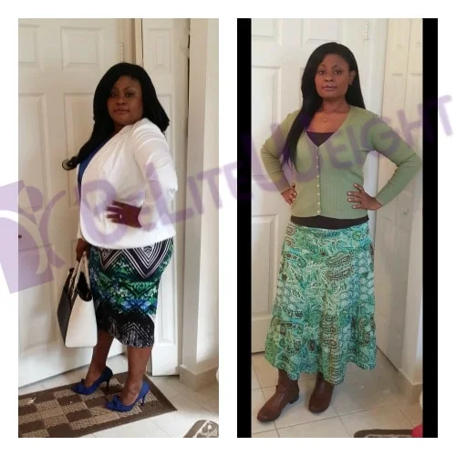 weight loss surgery before and after vsg vertical sleeve gastrectemy