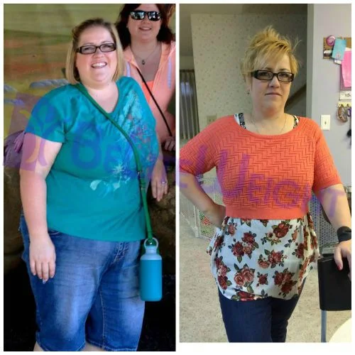 VSG Weight Loss Gastric Sleeve Photos