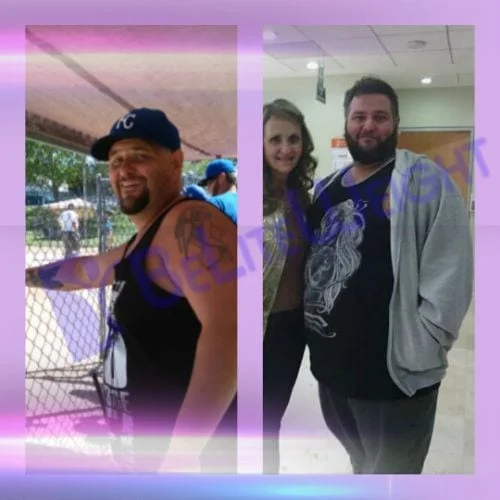 Weight Loss Surgery before and after Patient - I'm down to 265 from 350!* - Michael GSurgeon Dr. Jose Rodriguez and Elmo AramburoProcedure Gastric...