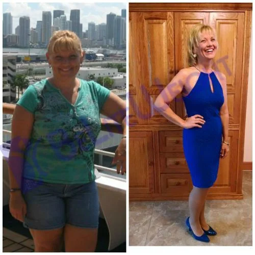 Weight Loss Surgery before and after Patient - *Surgeons Dr Jose Rodriguez and Elmo AramburoProcedure Gastric Sleeve*See Below