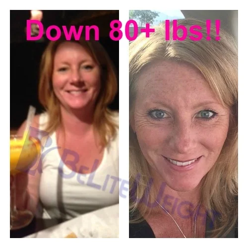 gastric bypass vsg surgery weight loss