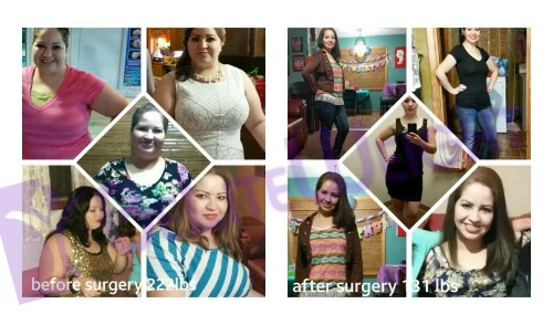 vsg gastric sleeve weight loss before and after surgery