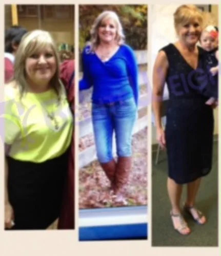 weight loss surgery vsg gastric sleeve before after photos testimonial