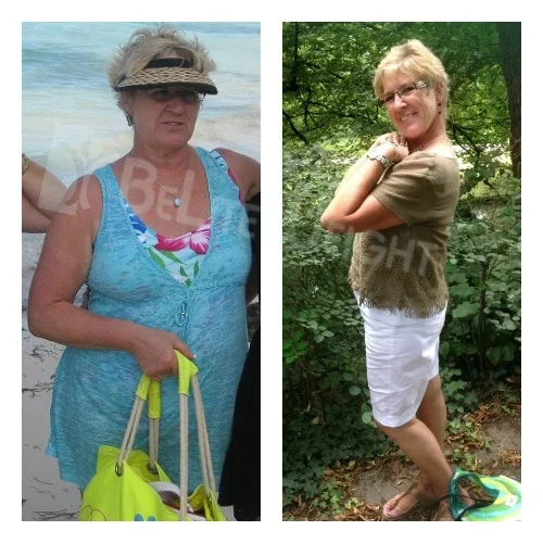 weight loss surgery before after bariatric vsg gastric sleeve bypass