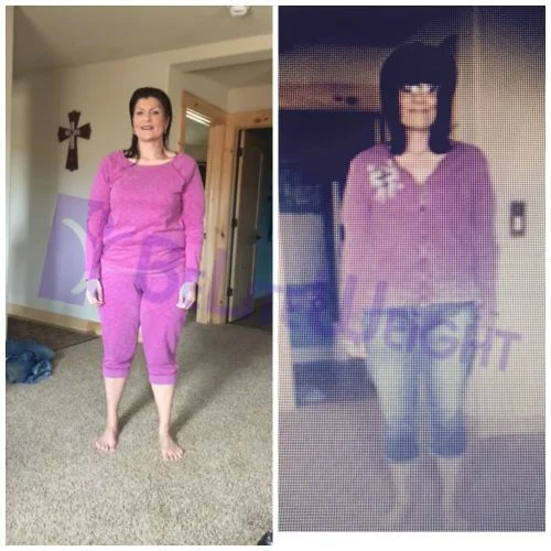 Weight Loss Surgery before and after Patient - I HAVE ABOSLUTELY NO REGRETS. THE TEAM IN JUAREZ WAS FANTASTIC, I WOULD RECOMMEND THEM...