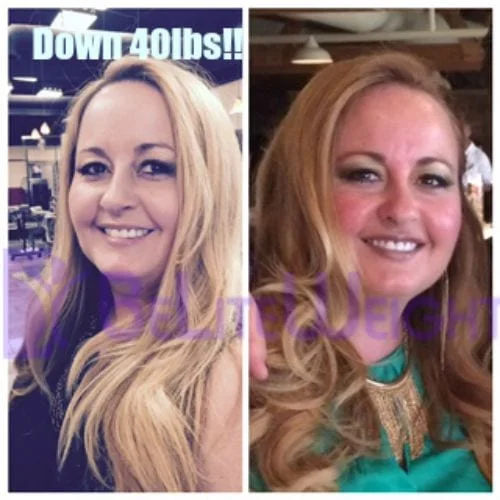 Gastric Sleeve Bariatric Surgery Before and After VSG Photos