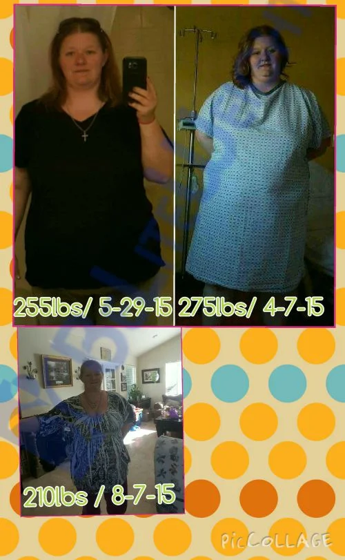 Weight Loss Surgery before and after Patient - 65lbs since surgery but a total of 90 since I started the pre-op diet 305...