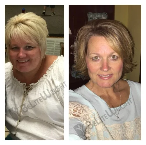 weight loss surgery vsg band sleeve gastric bariatric before after pictures