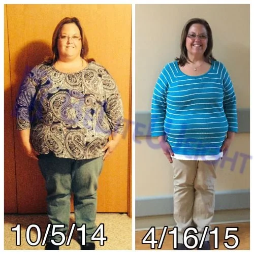 Weight Loss Surgery before and after Patient - I am down to 178 so I've lost 84 pounds in 6 months. I couldn't...