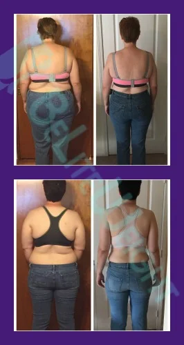 weight loss surgery vsg gastric sleeve vertical gastrectomy before and after