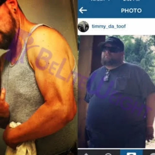 gastric sleeve vsg surgery weight loss