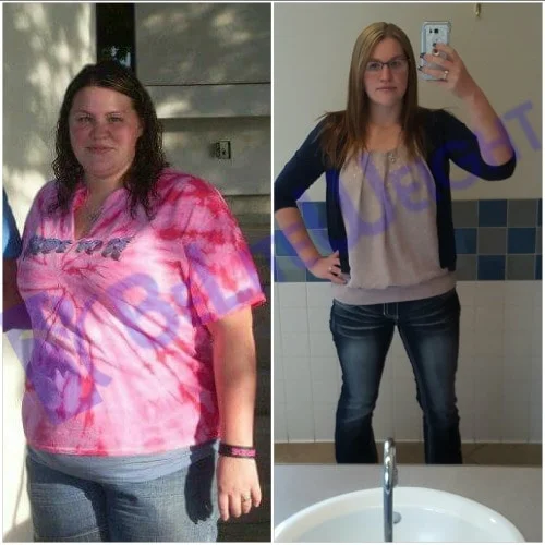 weight loss surgery vsg gastric sleeve before after photos testimonial revision after lap band