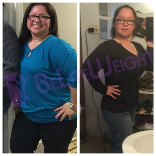 Weight loss surgery gastric bypass before after